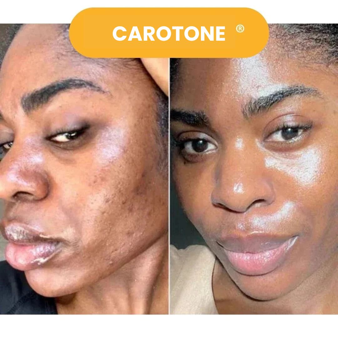 CAROTONE 300ML QUITA MANCHASTRATAMIENTO COMPLETO