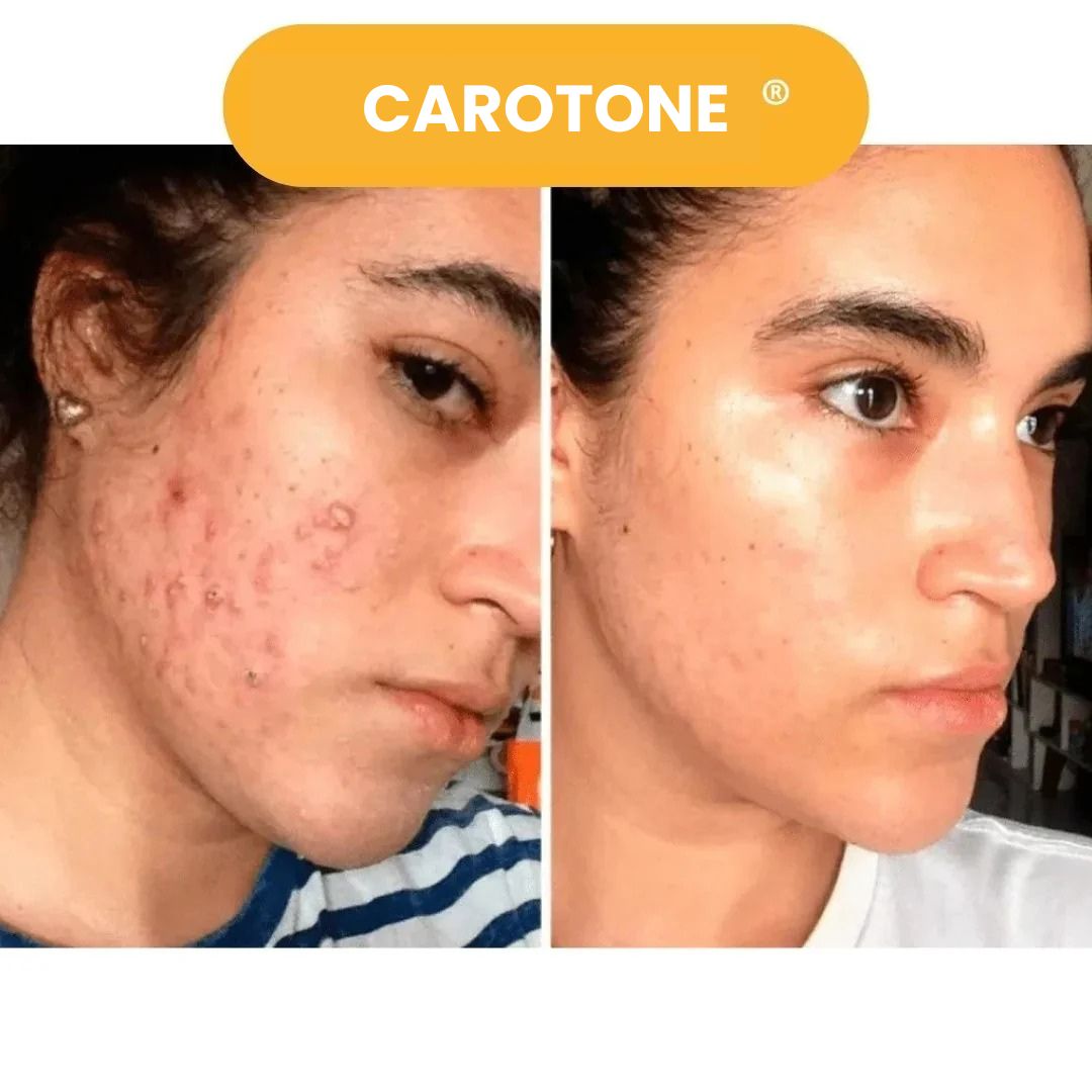 CAROTONE 300ML QUITA MANCHASTRATAMIENTO COMPLETO