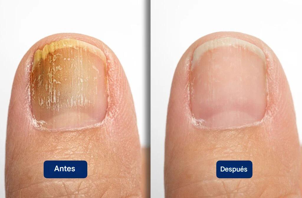 Fungal Nails® – No sigas escondiendo tus pies por culpa de los hongos